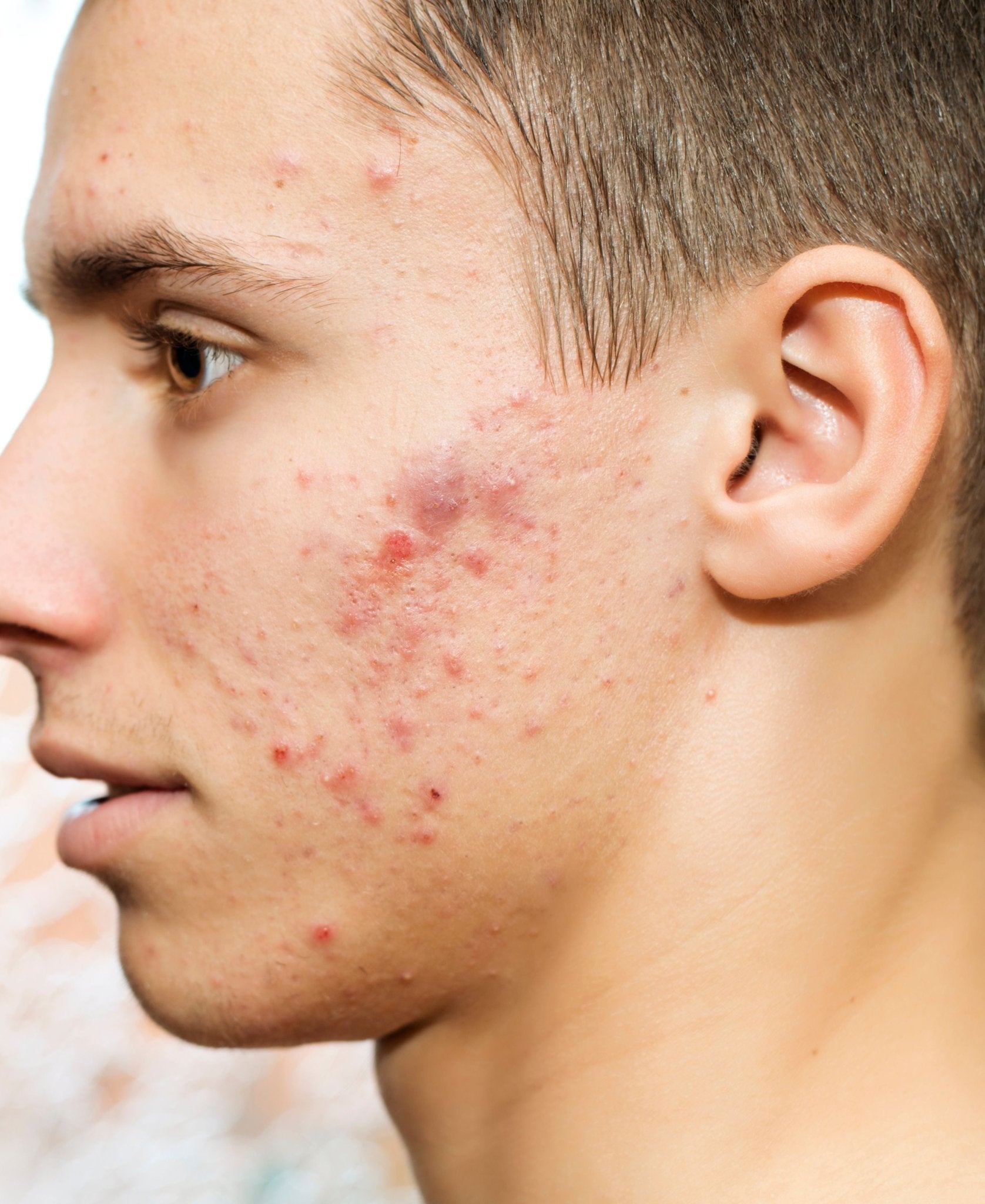 Comment se débarrasser définitivement de l'acné papuleuse ...