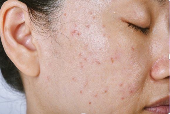 Does Stress Cause Acne - Dr Michele Green MD