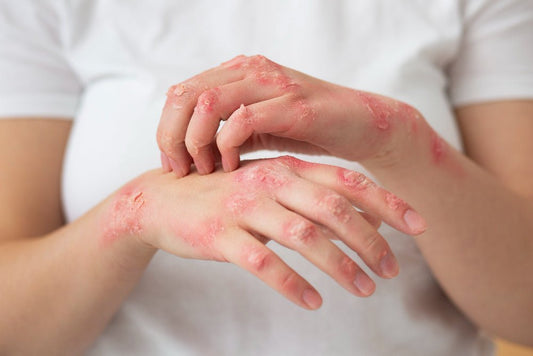 Soulager l'Eczéma Naturellement : Solutions Étayées par la Science - lofficinedumonde.fr