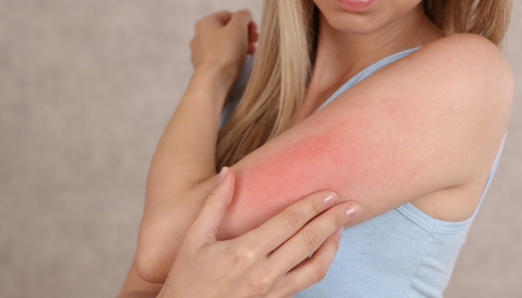 Comment se développe l'eczéma (la dermatite) ? - lofficinedumonde.fr