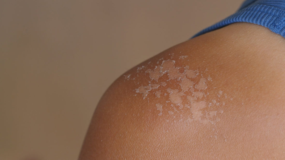 Coups de Soleil : Symptômes et Prise en charge complète - lofficinedumonde.fr