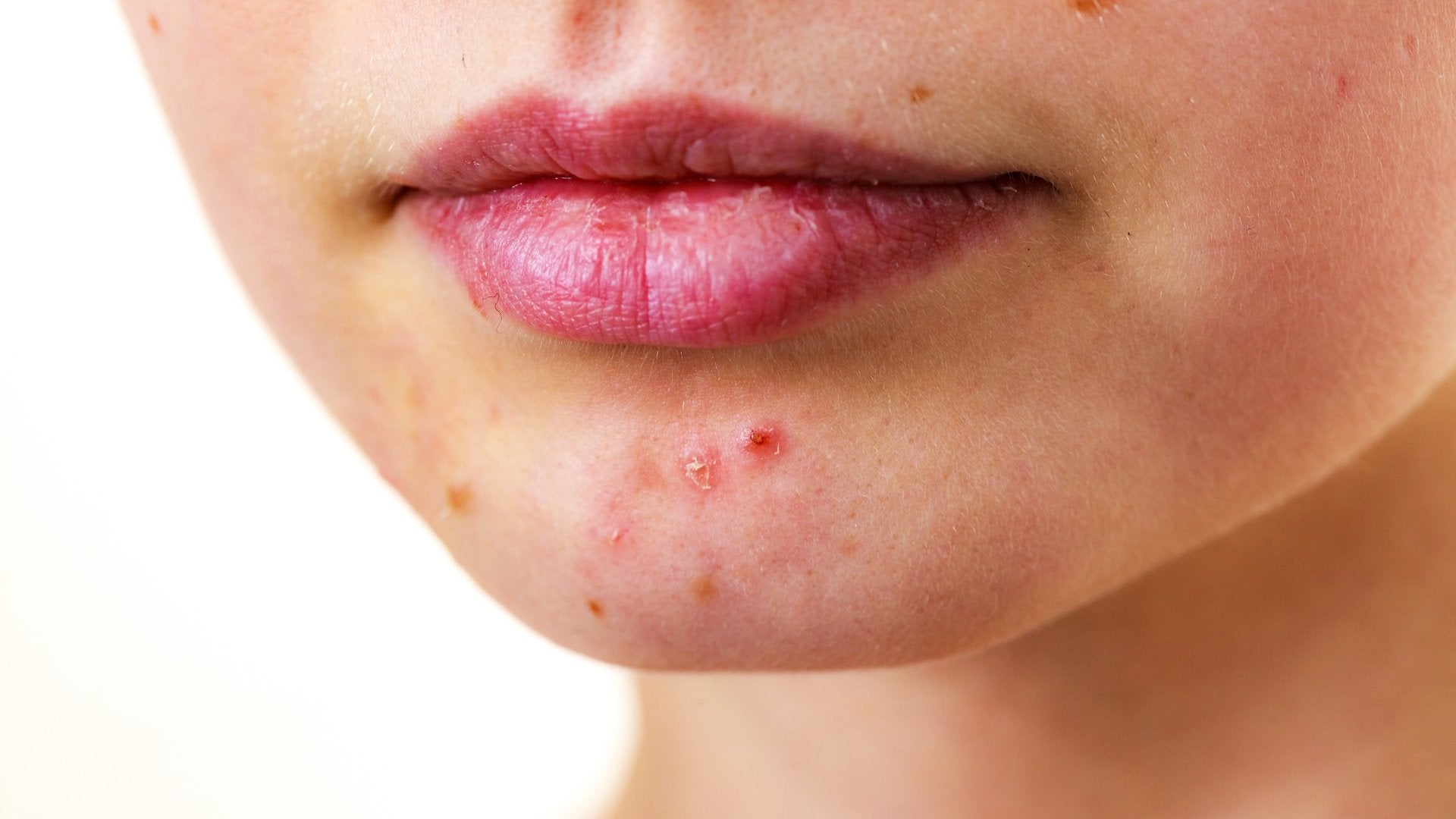 L'acné autour de la bouche : Des déclencheurs qui vous échappent peut-être - lofficinedumonde.fr