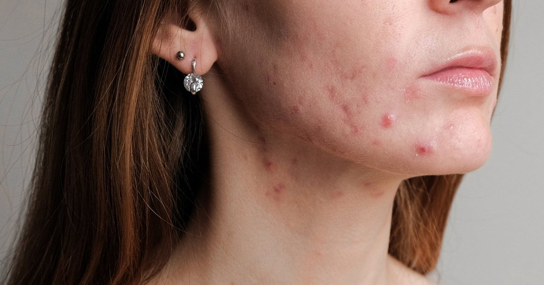 L’acné hormonale - lofficinedumonde.fr