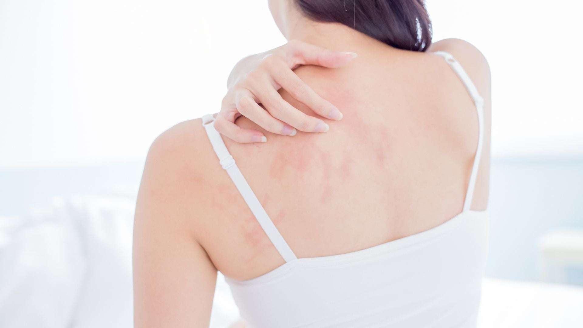 L'eczéma et la nigelle : Remède naturel pour apaiser la peau - lofficinedumonde.fr