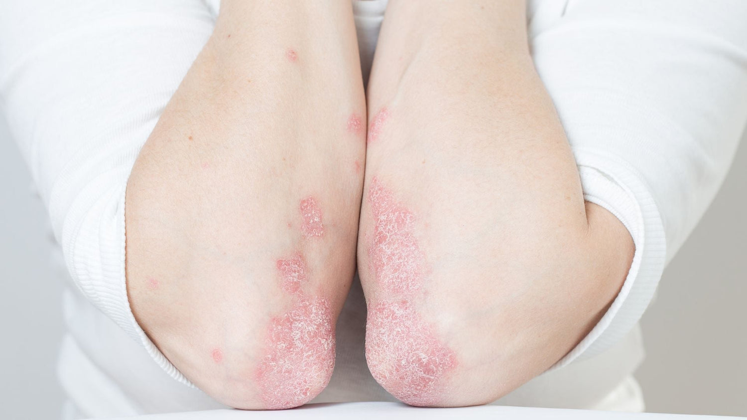 Traiter naturellement son Psoriasis - lofficinedumonde.fr
